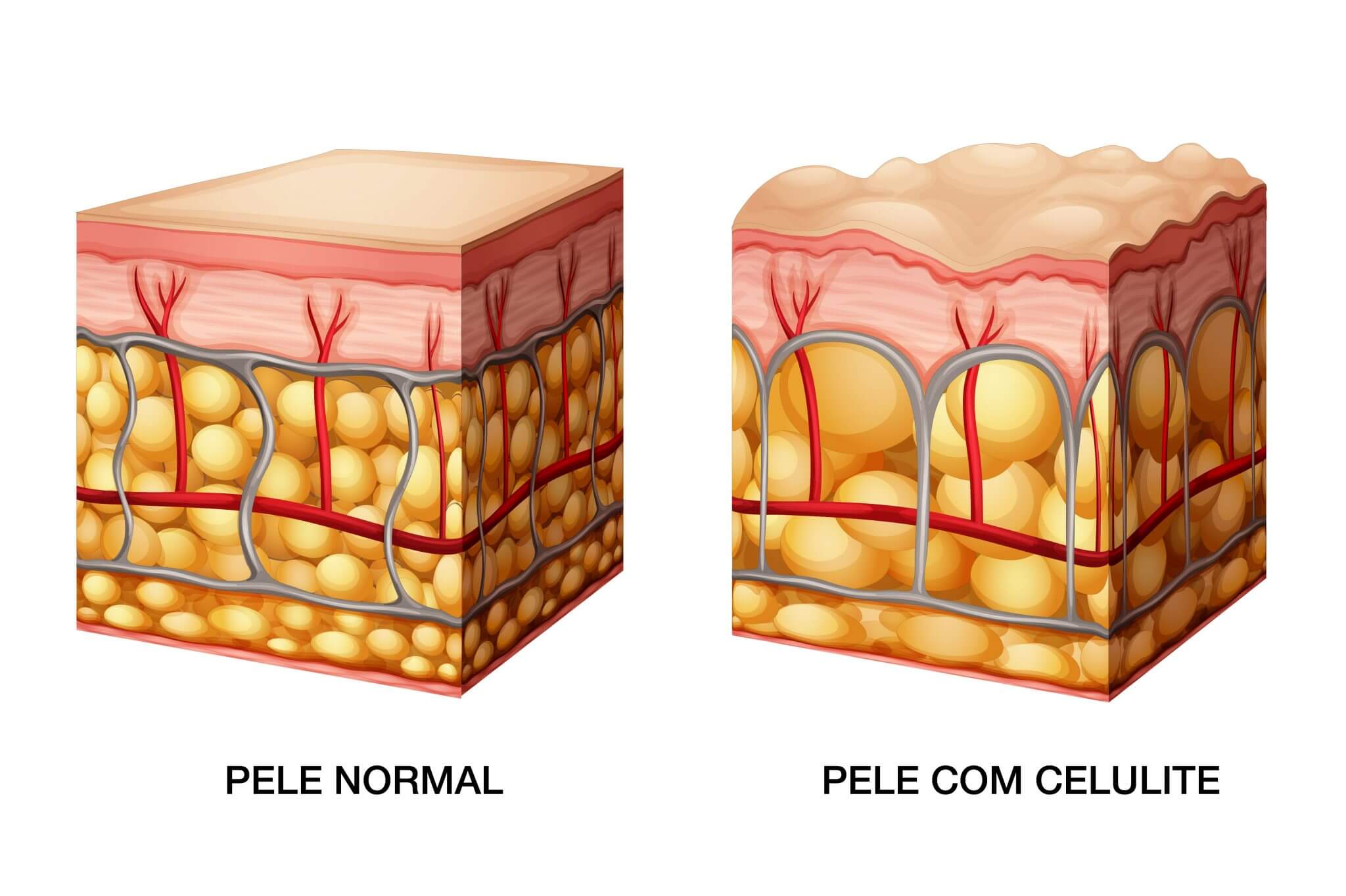 Formação de celulite