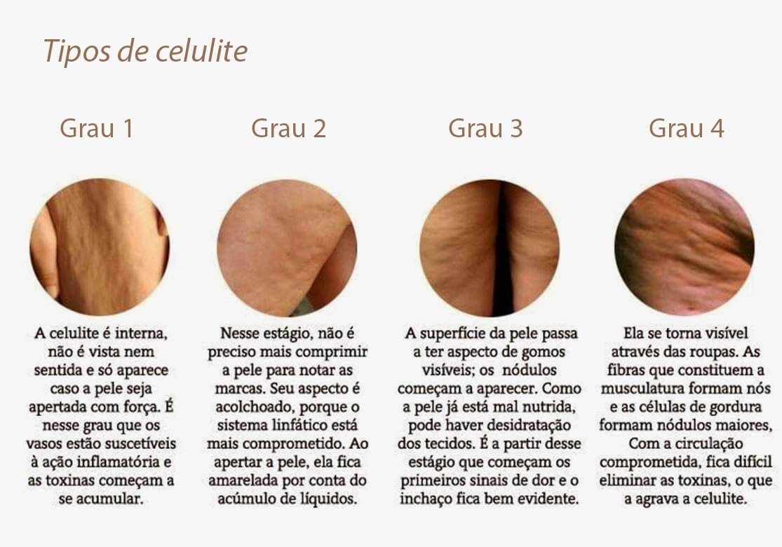 Tipos de celulite