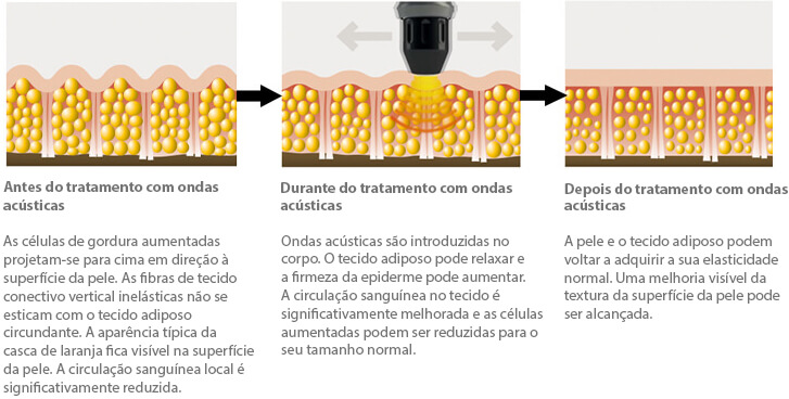 Ondas acústicas como funciona